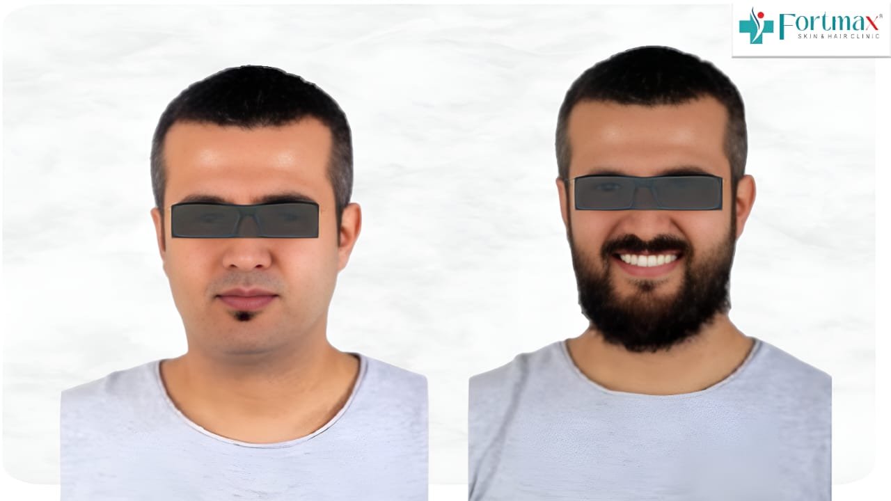 Beard-transplant