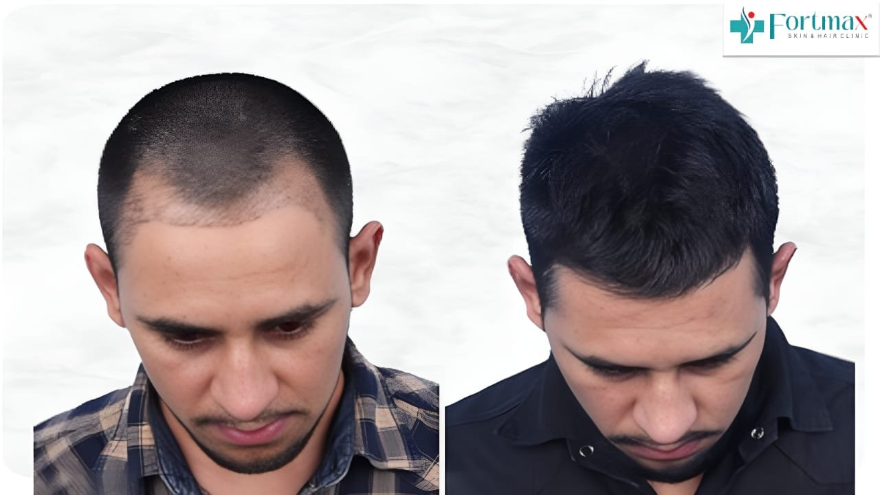 Hair-line