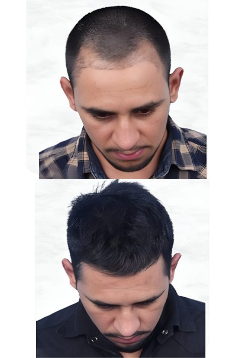 hairline-reconstruction-service2-inter