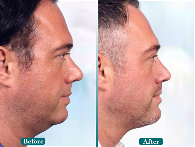 Eyebrow-reconstruction.jpg