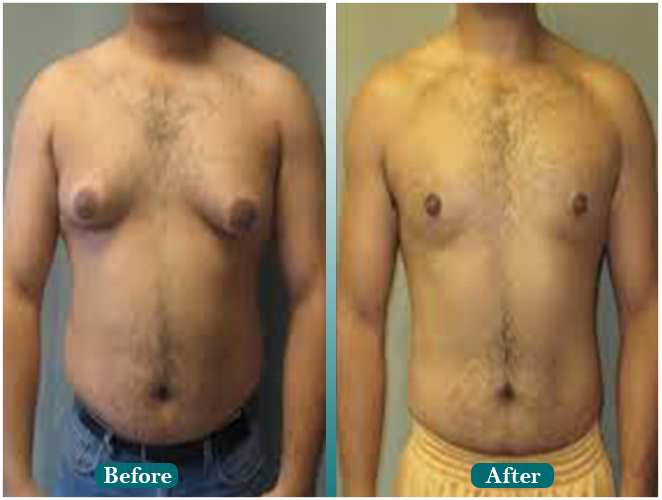 Female-hair-transplant