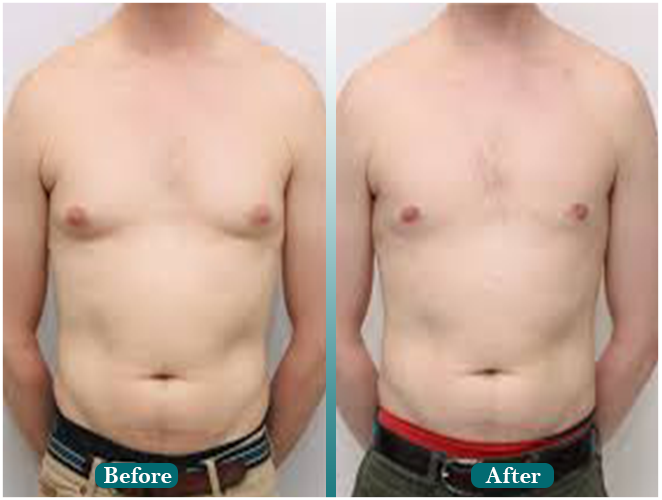 Beard-transplant