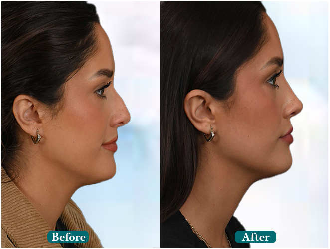 Female-hair-transplant
