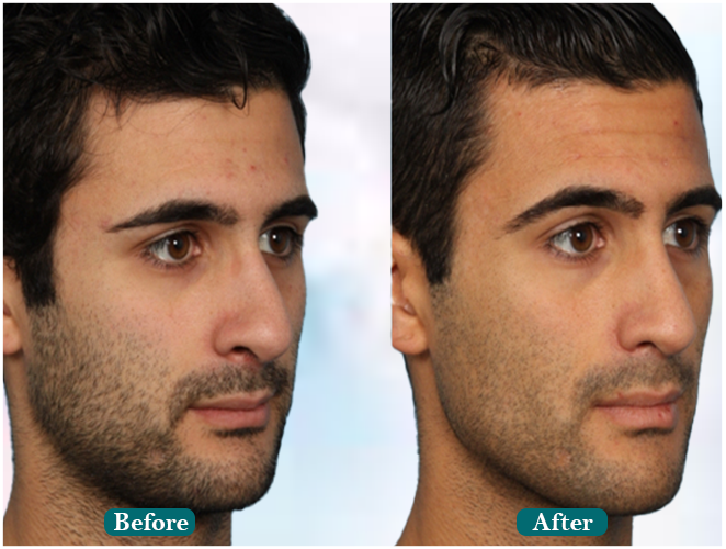 Beard-transplant