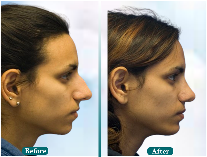 Eyebrow-reconstruction.jpg