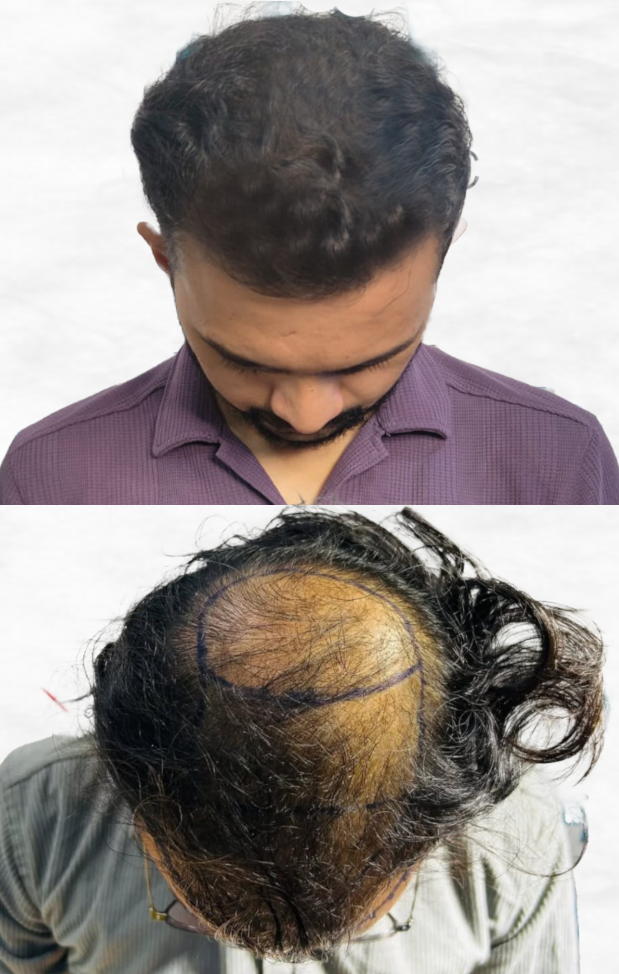 shami-hair-transplant-latest